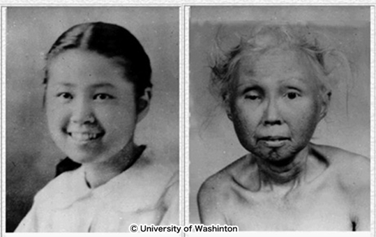 Accelerated aging in a patient with Werner syndrome